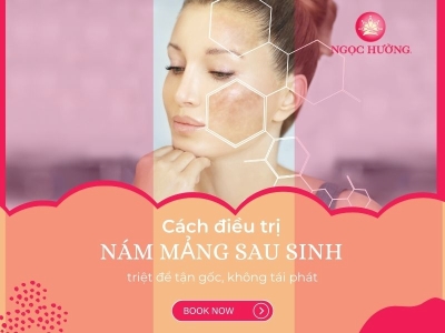 Nám mảng là gì? Cách trị nám mảng sau sinh tận gốc không tái phát