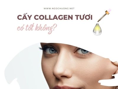 Review Cấy Collagen Tươi Có Tốt Không? Có Tác Dụng Gì?