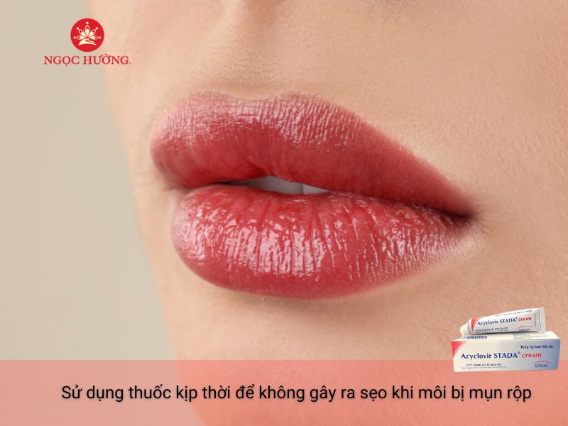 Phun môi bị mụn nước bôi thuốc gì tốt nhất và an toàn nhất #7 Phun môi bị mụn nước bôi thuốc gì tốt nhất và an toàn nhất