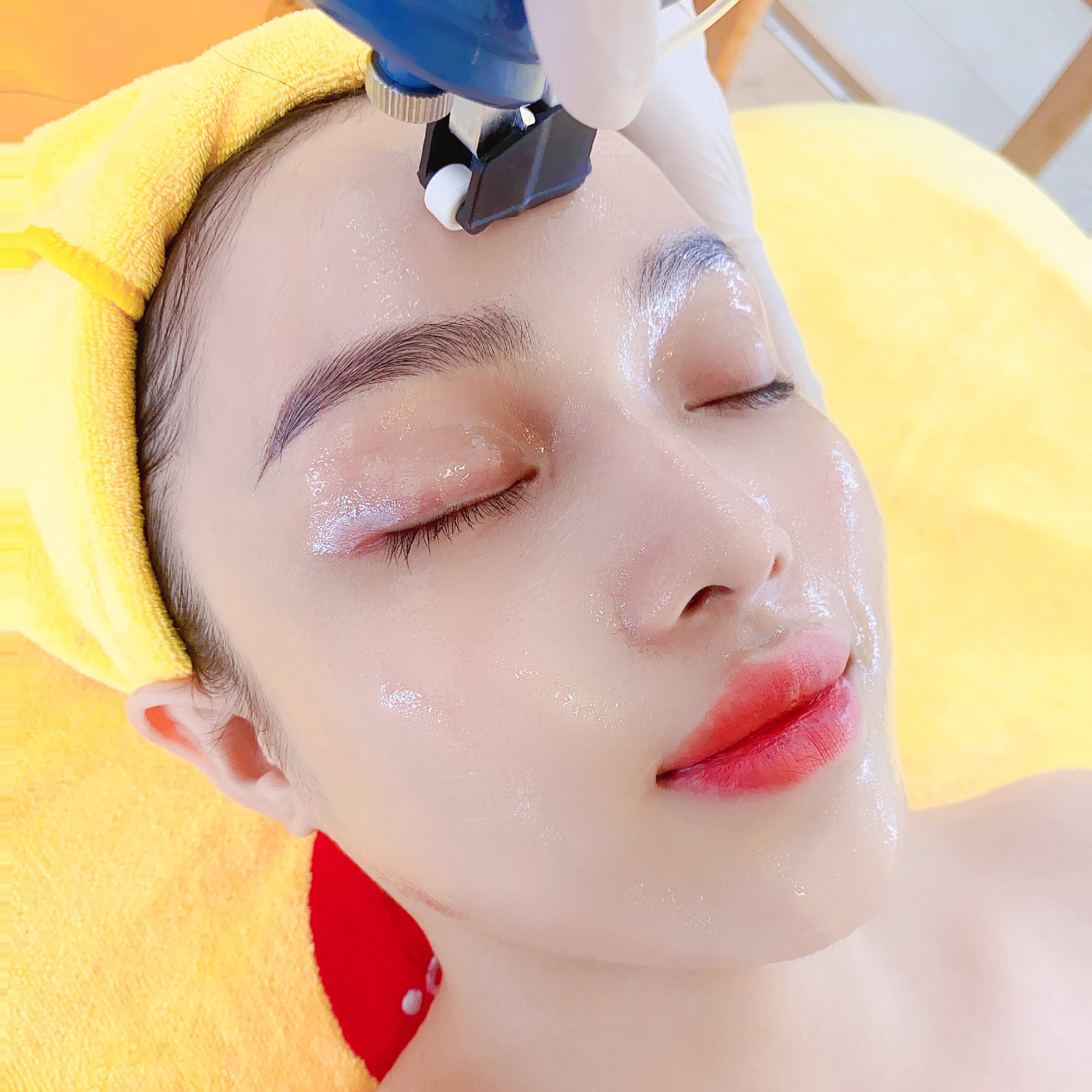 trị mụn