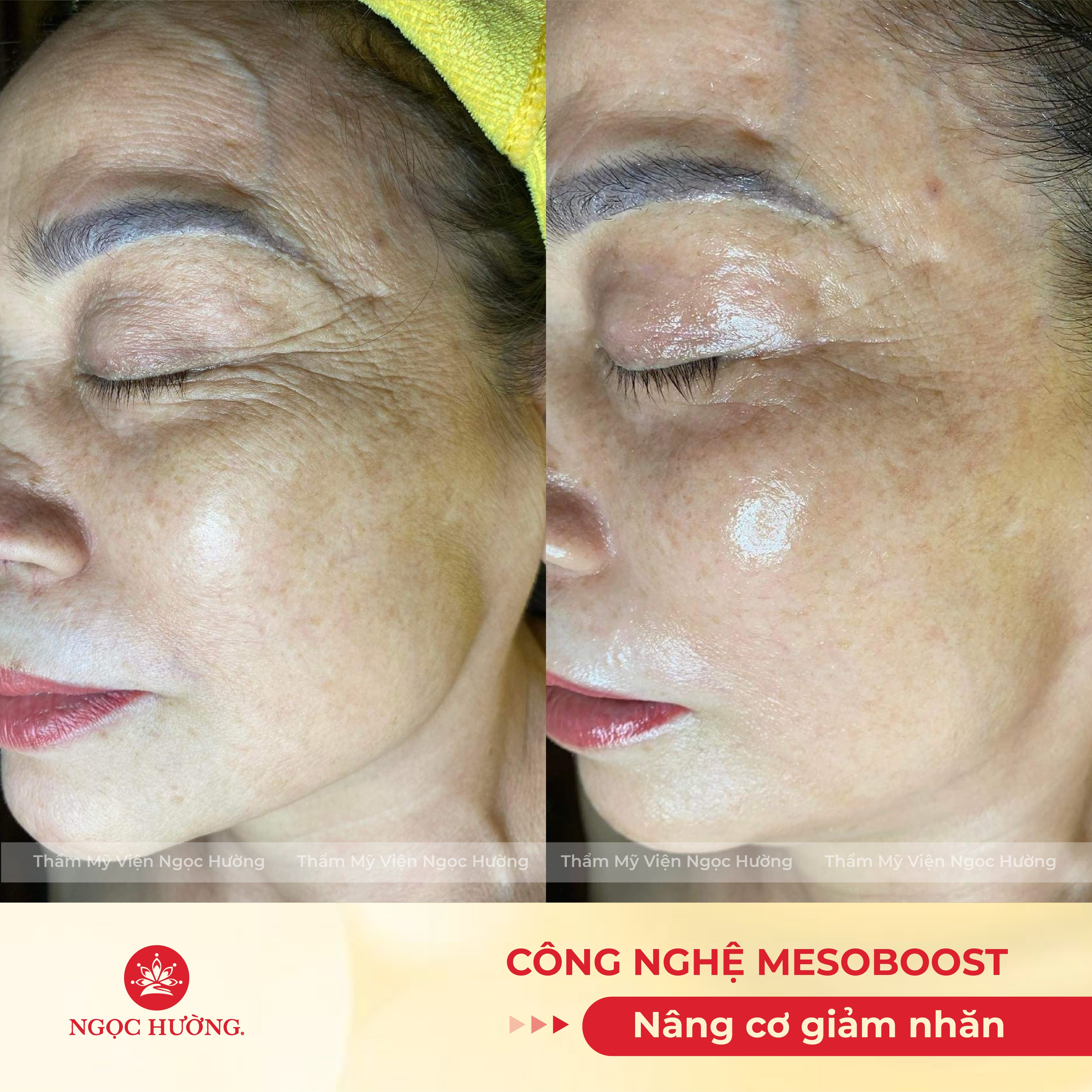 trị mụn