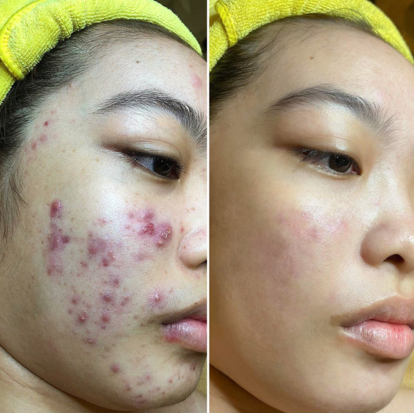 trị mụn