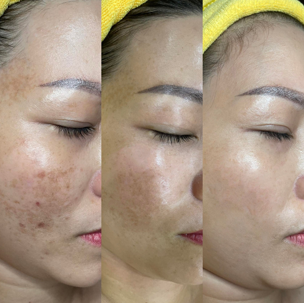 trị mụn