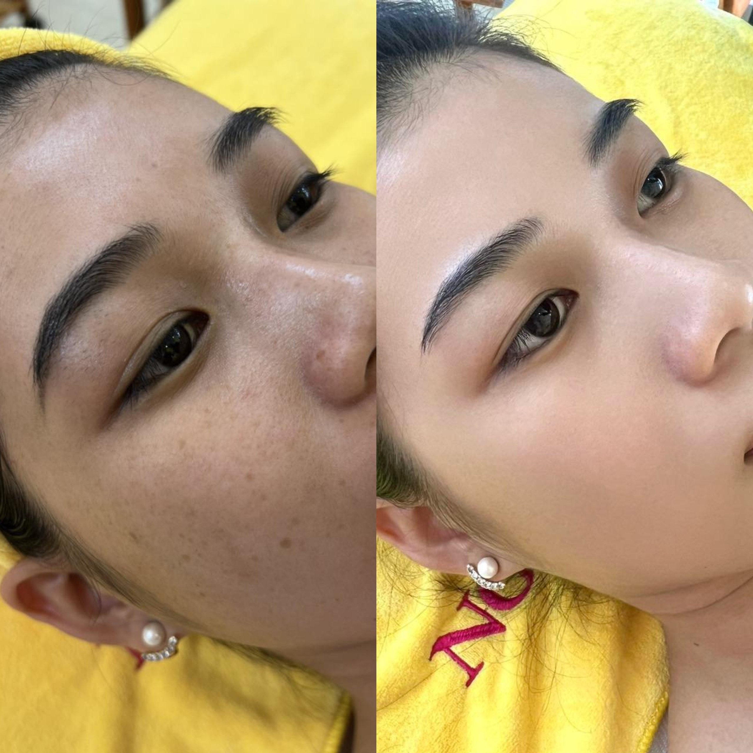 trị mụn