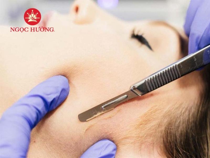 Triệt lông mặt có gây hại hay không phụ thuộc vào nhiều yếu tố, đặc biệt là việc chăm sóc trước và sau khi triệt