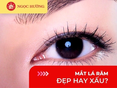 Mắt lá răm là gì? Người mắt lá răm là người như thế nào?