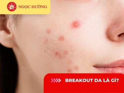 Breakout da là gì? 5 nguyên nhân khiến breakout da bạn nên biết