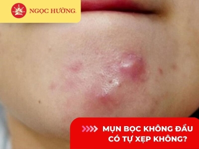 Mụn bọc không đầu có tự xẹp không? Có nên nặn không?