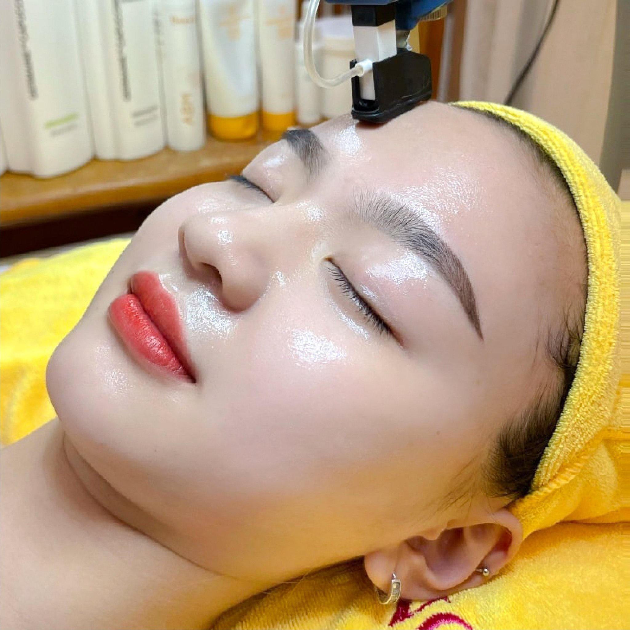 cấy collagen ngọc hường