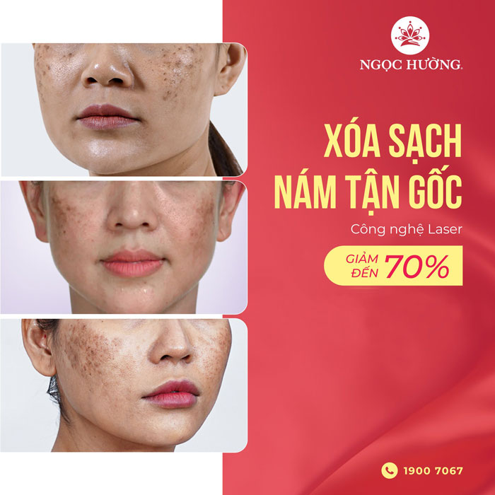 trị nám